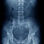 spine Surgery